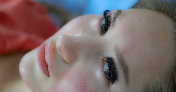 žena-rosacea-lice