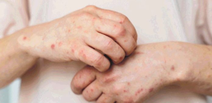 Neugodna zarazna bolest prisutna u FBiH: Do sada zabilježeno više